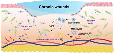 New insights into the role of cellular senescence and chronic wounds